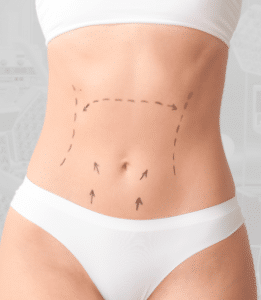 Abdominoplastia