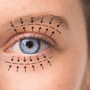 Blefaroplastia